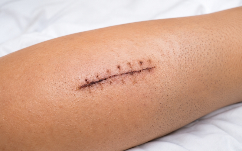 Mobile wound care specialist assessing a patient's wound at home