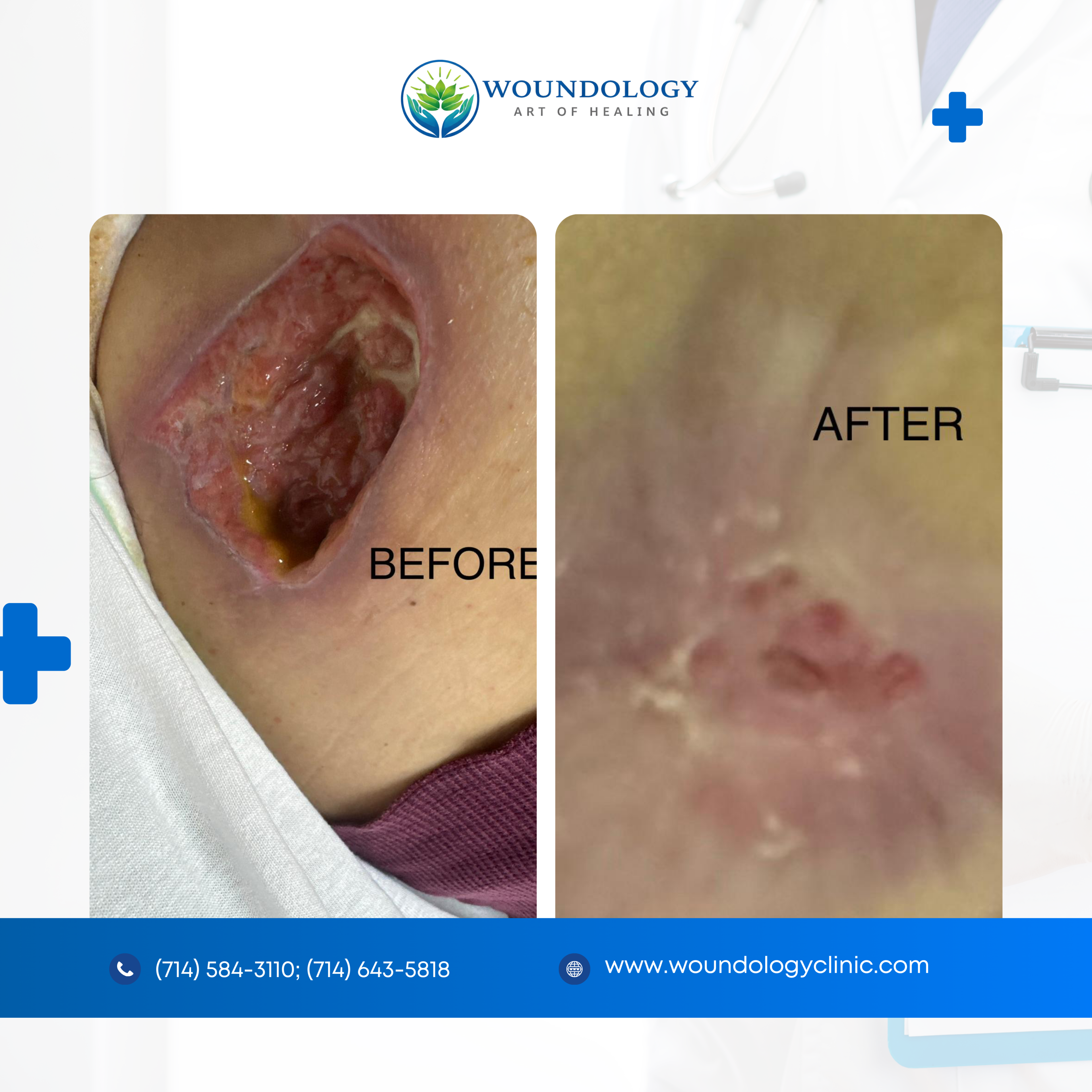 before and after chronic wound treatment by Woundology