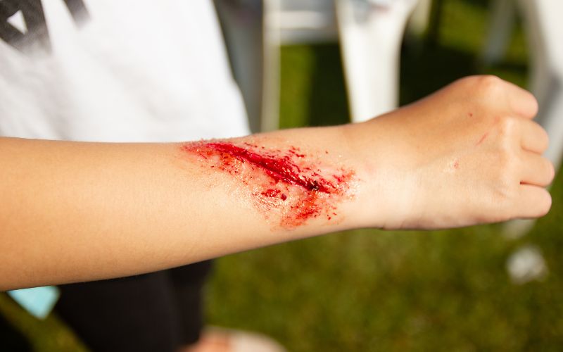 Signs of an Infected Open Wound