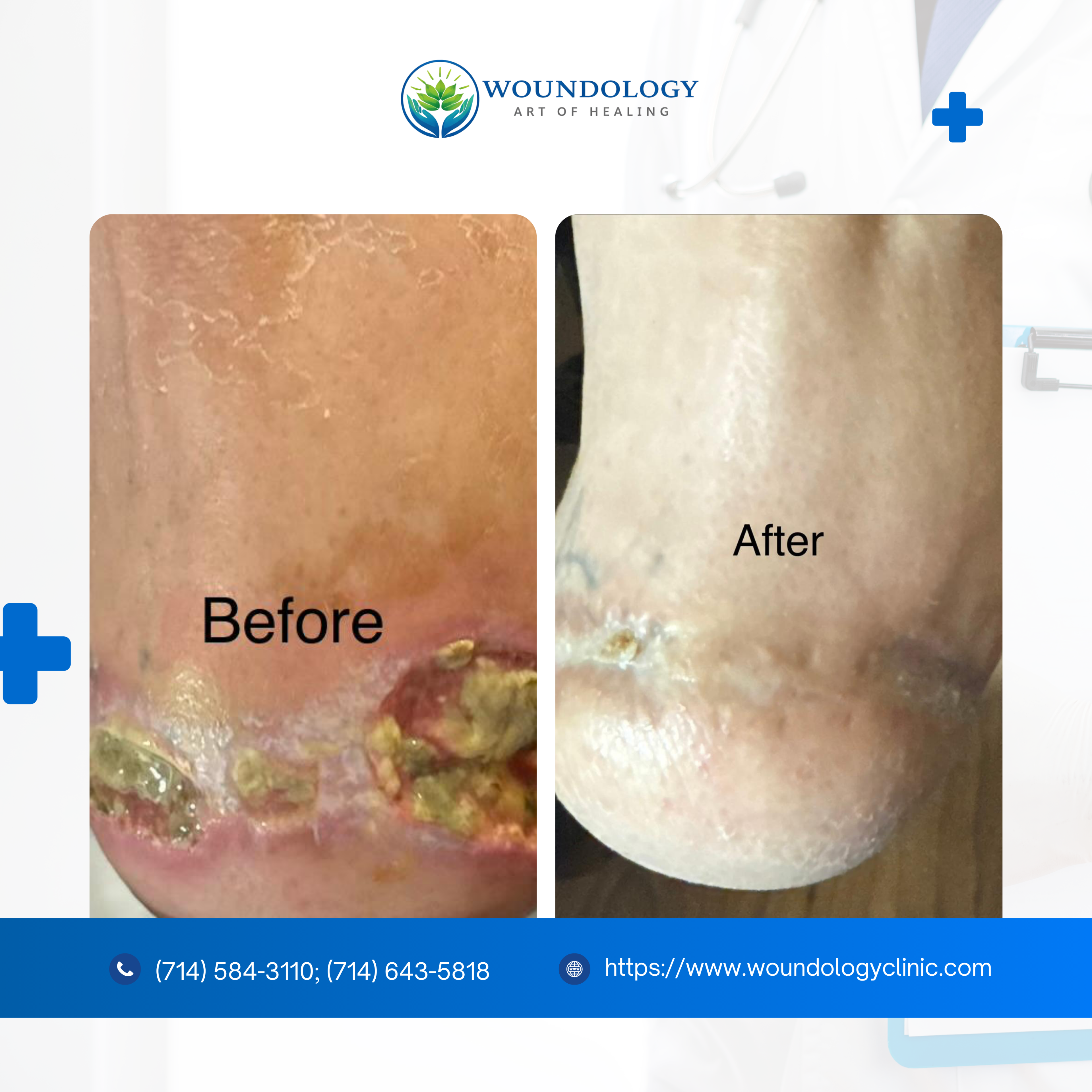 Before and after wound care by Woundology