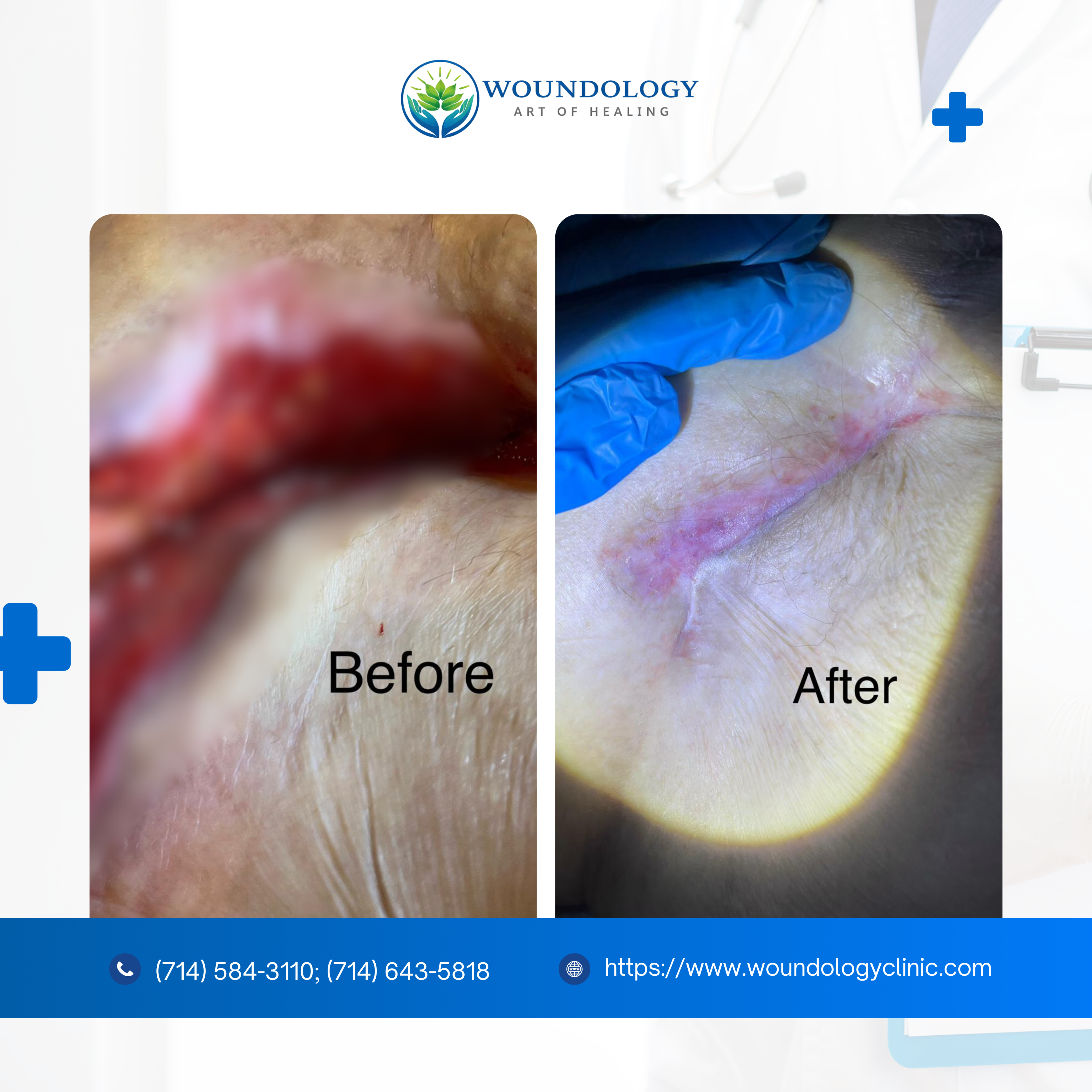 Before and after wound care by Woundology