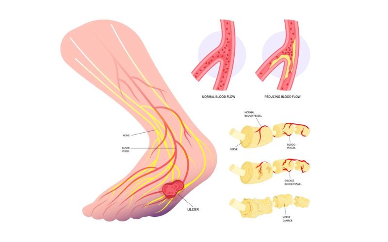 Diabetes impact on wound healing
