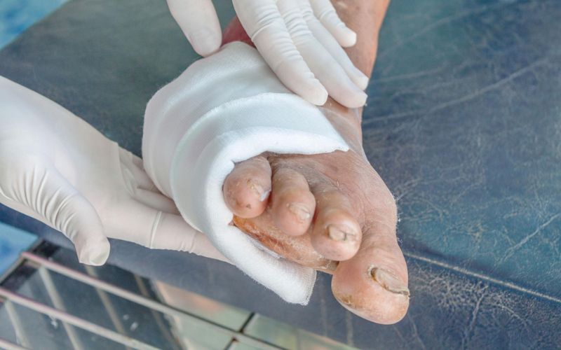 Improper wound care due to diabetes can easily lead to infection