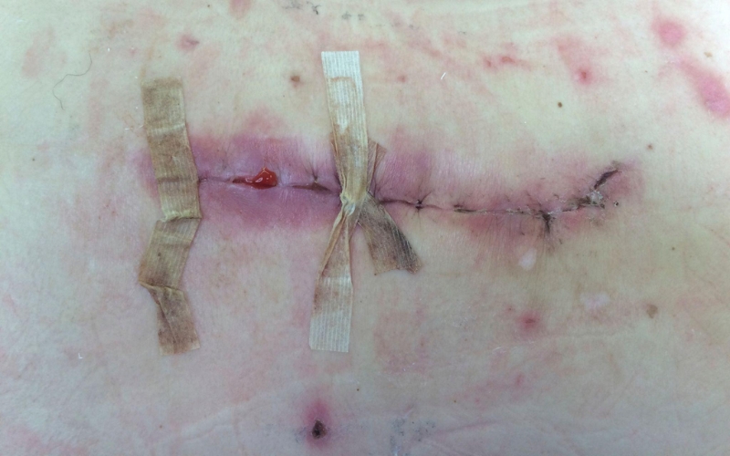 Signs of post-surgical wound infection requiring professional care