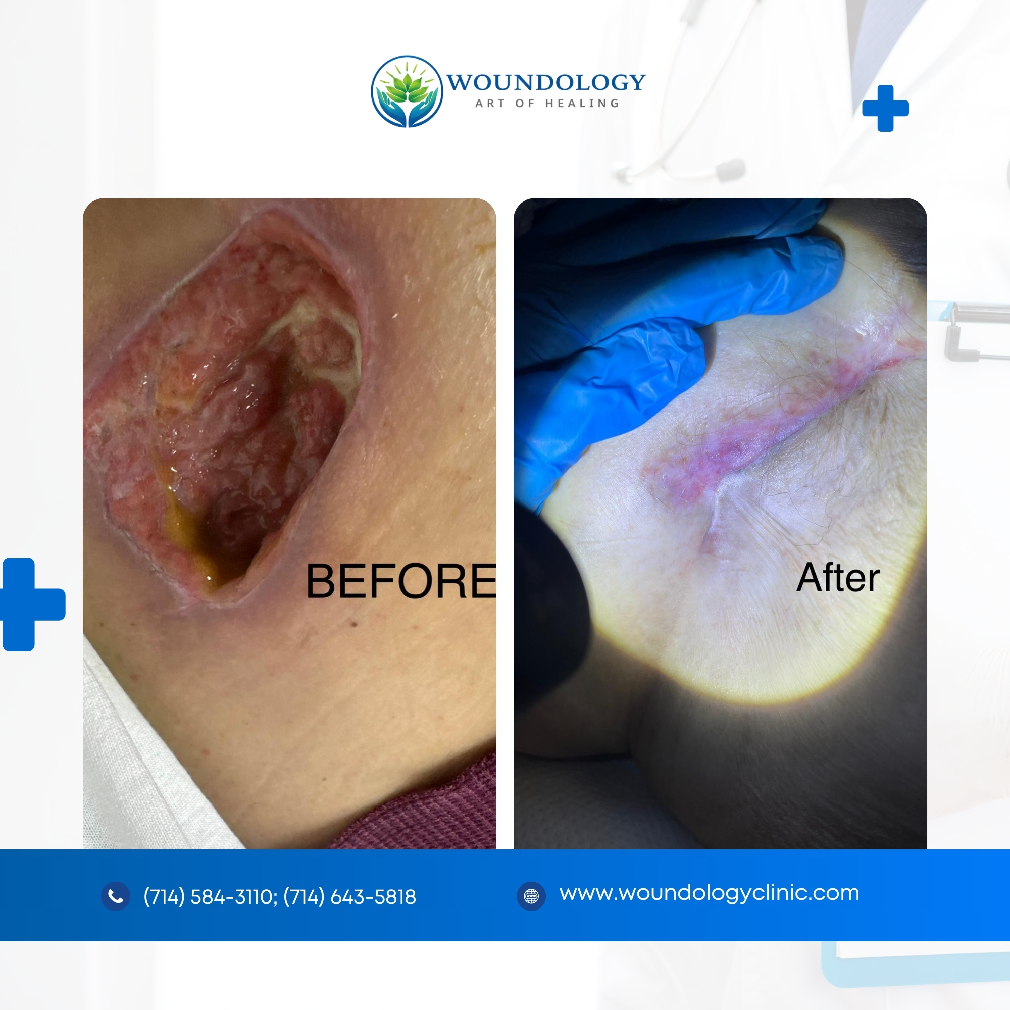 Wound Care Before and After Results