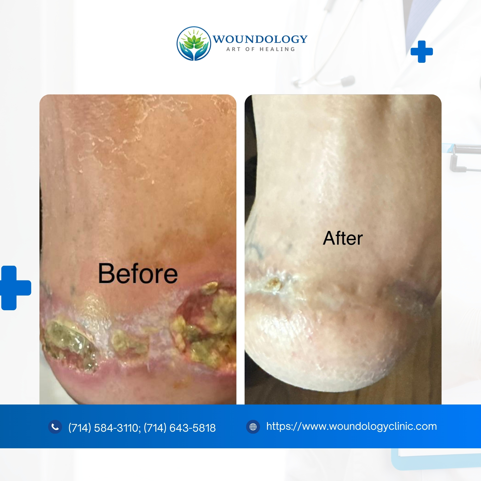 Wound Care Before and After Results