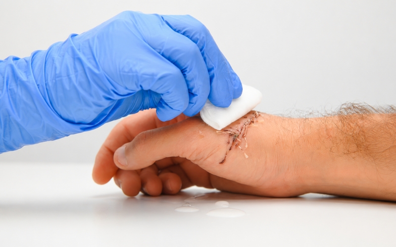 If a wound is not healing, getting worse, or showing signs of infection, it may be time to see a wound specialist