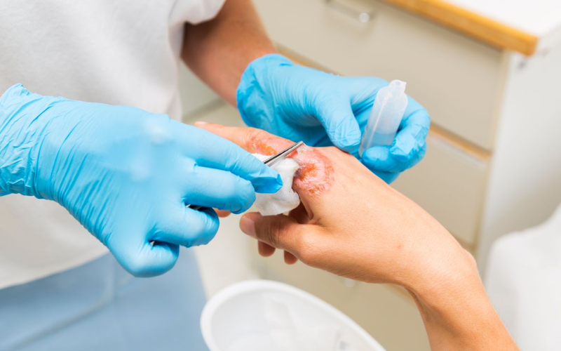 Chronic wounds require specialized treatment to prevent complications and preserve healthy tissue