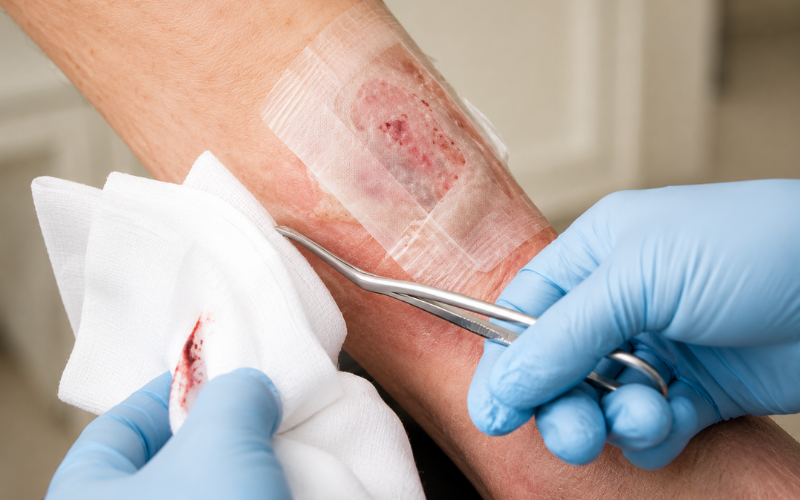 Advanced Wound Healing Care at Home