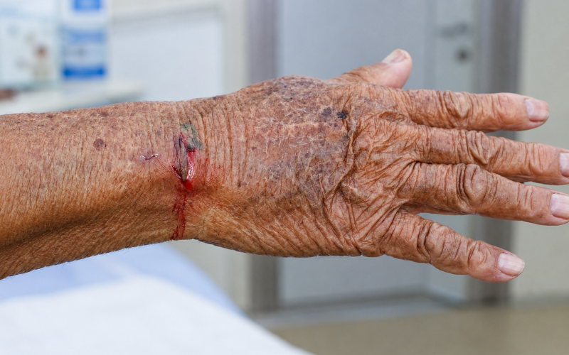 Aging skin changes in older adults